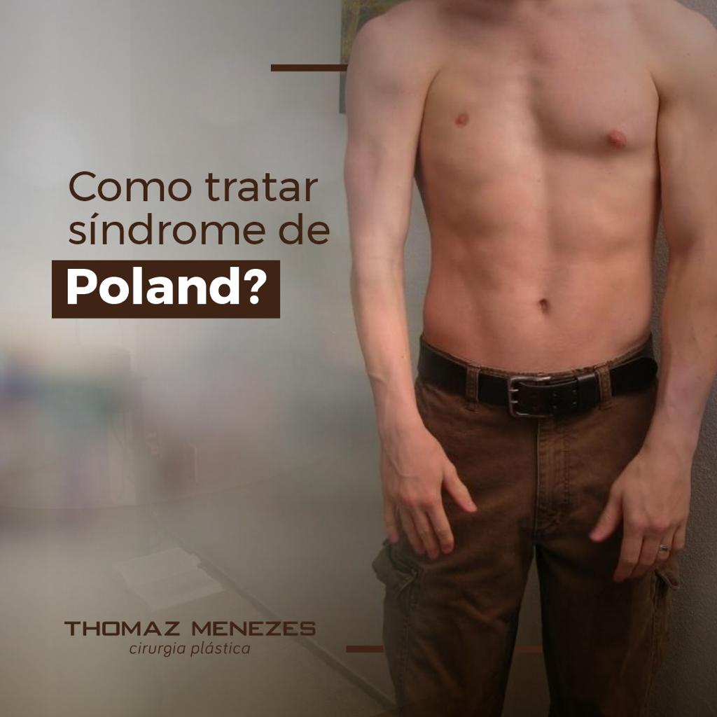 ComoTratarSindromePoland